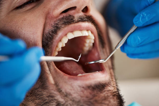 Best Chipped Tooth Repair Near Me  in Orchard Mesa, CO